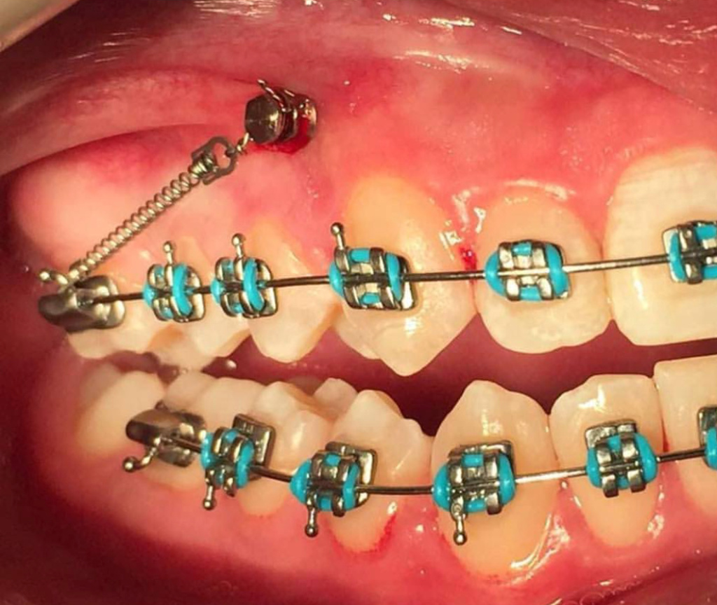 Advanced Orthodontic Procedures Course [Orlando] HDM INSTITUTE